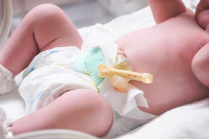 umbilical cord complications